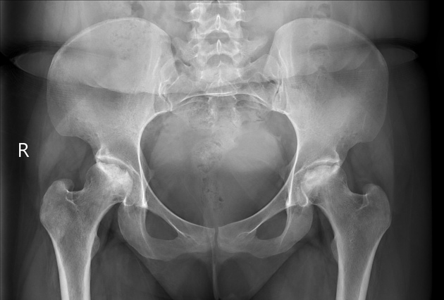 Femur Başının Avasküler Nekrozu (AVN):