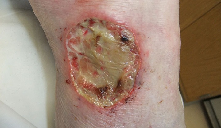 VAKA: Bacakta Kapanmayan (pre-Tibial) Yaralar