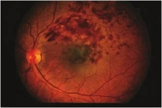 Diyabetik Retinopati: Moleküler Restorasyonun Biyolojik Kodları