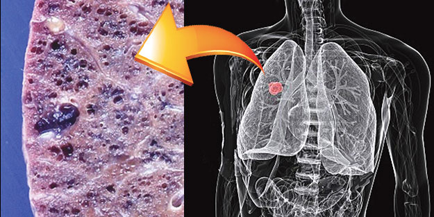 Fibrozis: Organlarda Sertleşme & Bitkisel Anti-fibrotik Destek