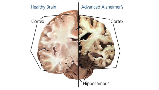 Egzersiz Demans (Alzheimer) Riskini Azaltıyor.