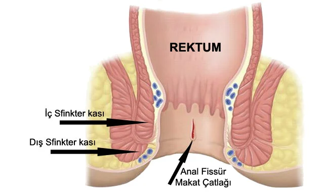 Anal Fissür (Makat çatlağı): Anorektal Bölge Lezyonlarına Klinik Yaklaşım