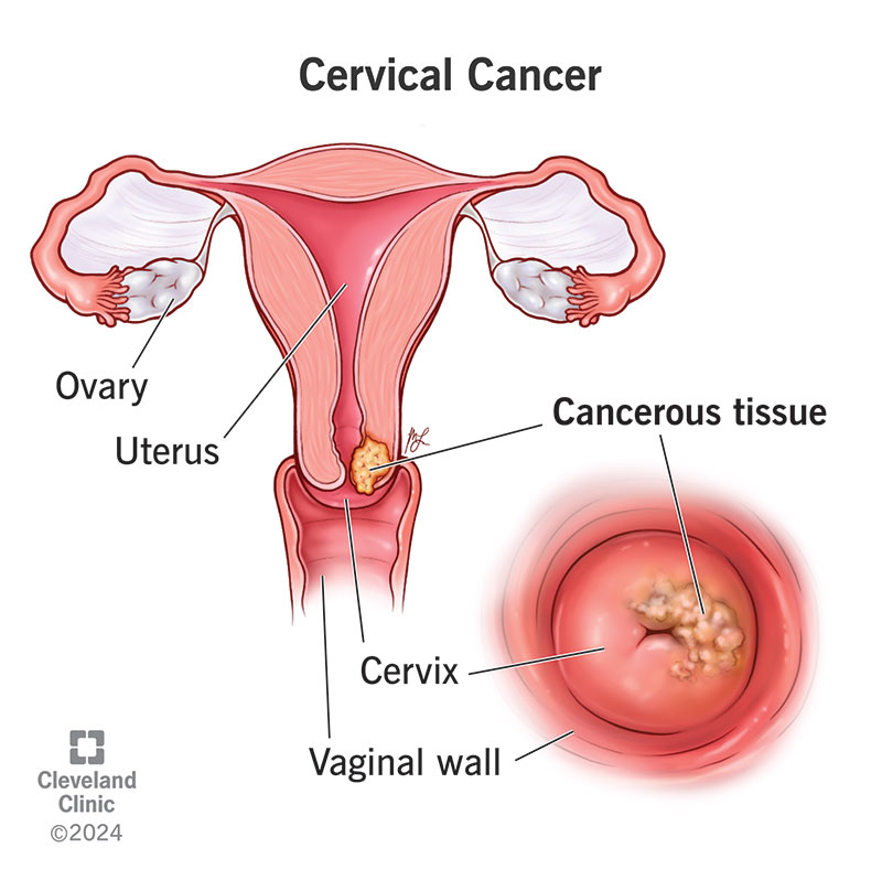 Rahim Ağzı Kanseri ve HPV: Hücresel Düzensizlikten Bütüncül Tedavi Yaklaşımlarına