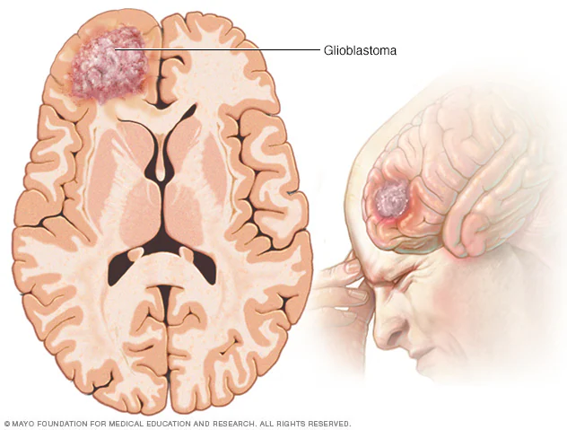 Glioblastoma ve B3 Vitamini (Niasin) Üzerine Umut Verici Bir Çalışma