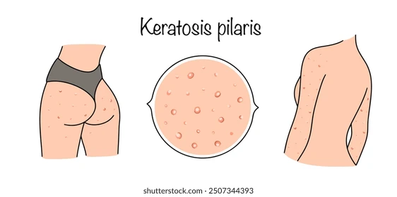 Keratosis Pilaris (Tavuk Cildi): Kıl Kökünde Keratin Birikimi
