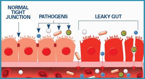 Leaky Gut  (Geçirgen/Sızdıran Barsak) Sendromu