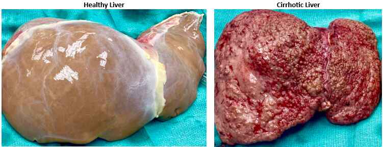 Siroz (Karaciğer fibrozu): Tanı & Tedavi