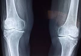Osteoartrit Tedavisinde Atılım:   İlaç Kombinasyonu Hayvan Çalışmasında Artriti Tersine Çevirdi