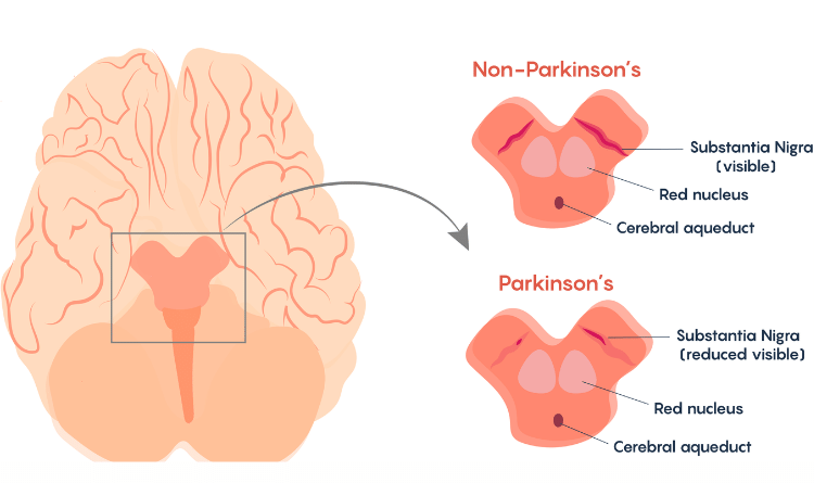 Parkinson hastalığı & Dopamin Yönetimi