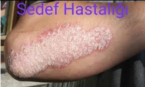 Psoriazis (sedef Hastalığı)