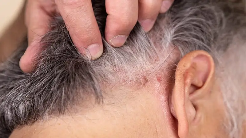 Saçlı Deride Seboreik Dermatit