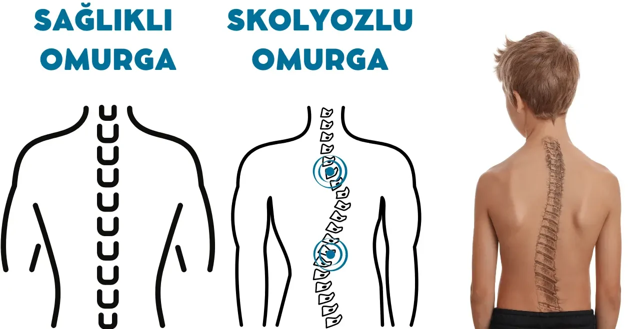 Skolyoz