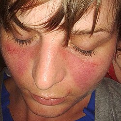 Sistemik Lupus Eritematozis (SLE)