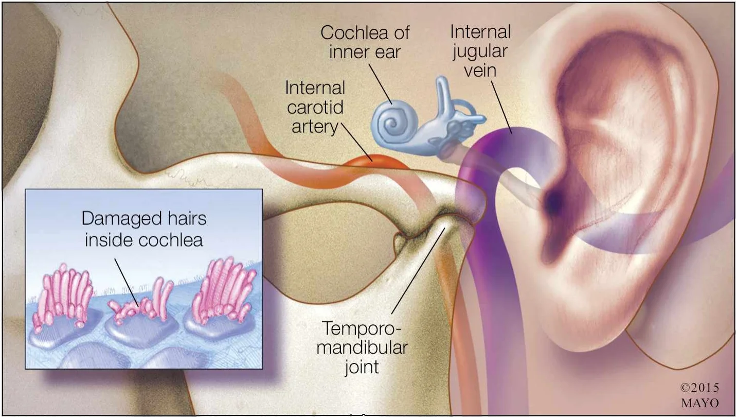 Kulak Çınlaması (Tinnitus):