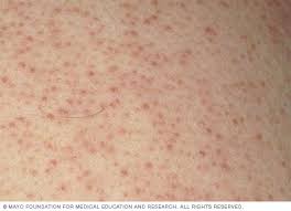 Keratosis Pilaris (KP)