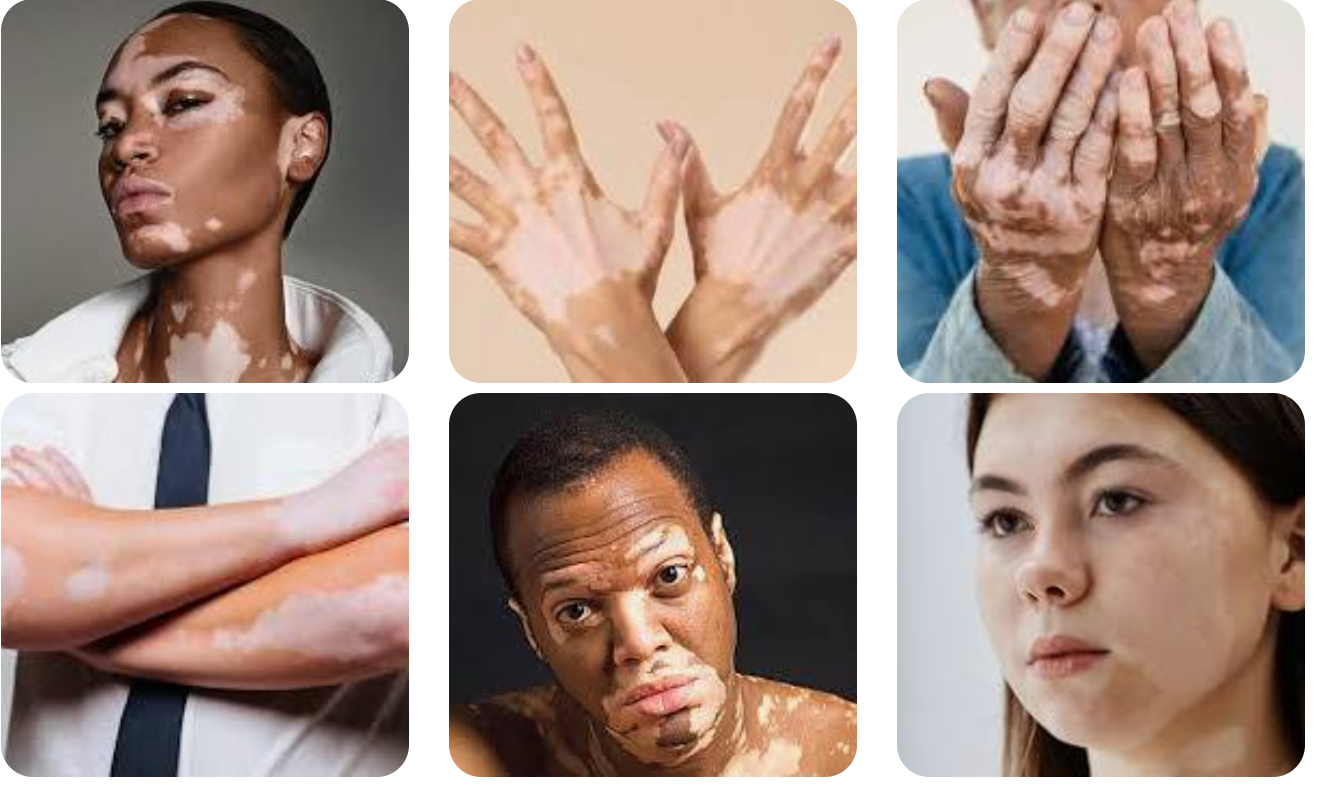 Vitiligo'nun Hücresel Biyolojisi, Otoimmün Mekanizmaları ve Bütüncül Tedavi Yaklaşımları